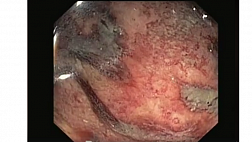 Обзор. Ишемический колит 2017. Нижние отделы